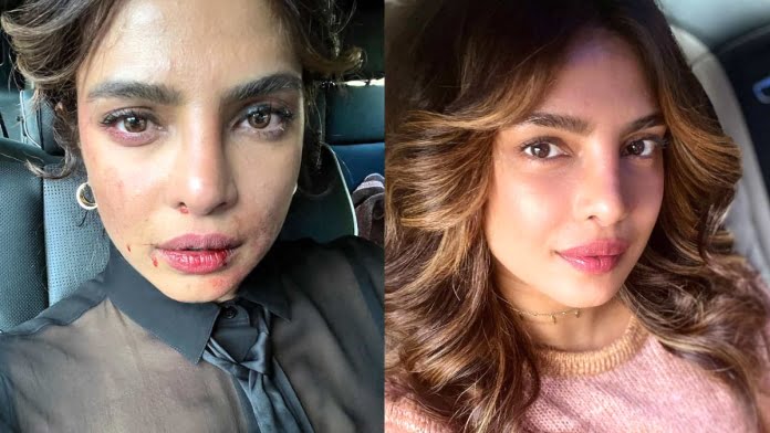 Priyanka Chopra Shares Picture Of 'bruised' Face!! Find Out What Caused It