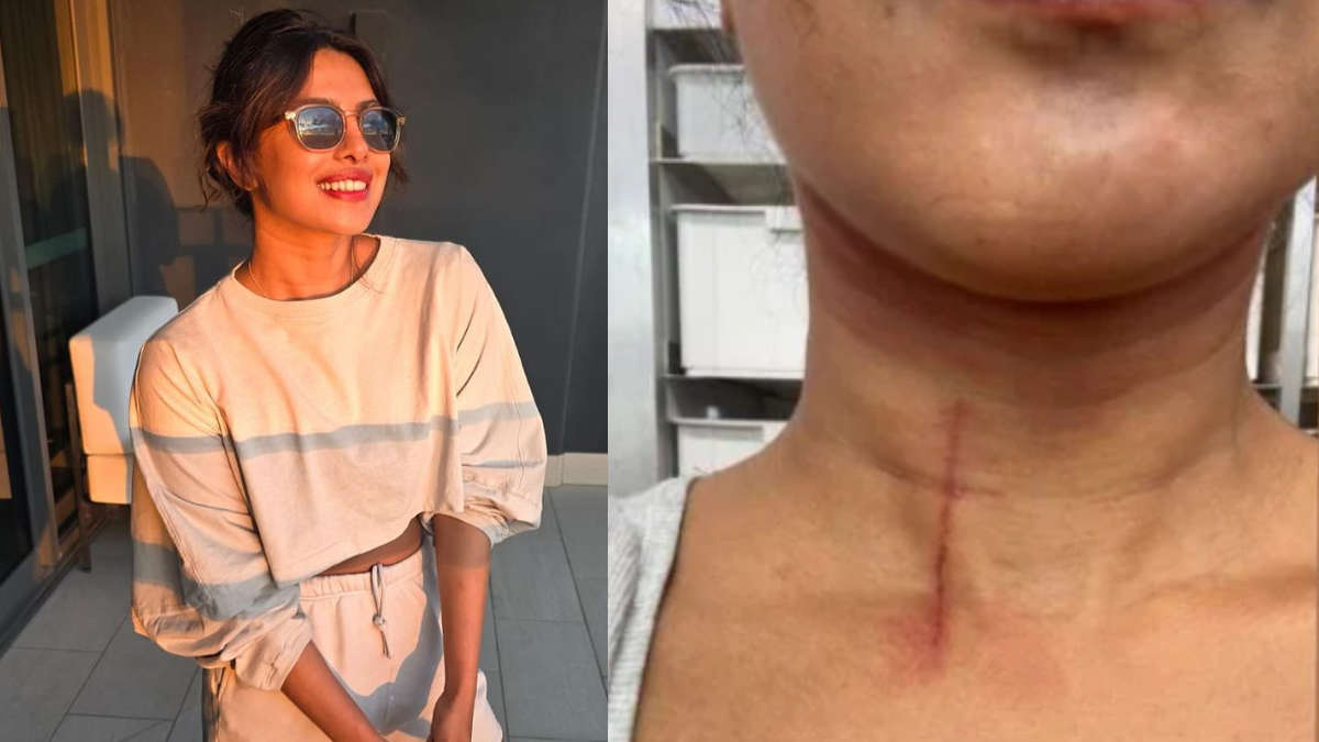 Priyanka Chopra suffered an injury on the sets of “The Bluff”